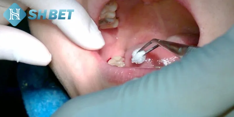 Giải mã giấc mơ nhổ răng và các con số liên quan